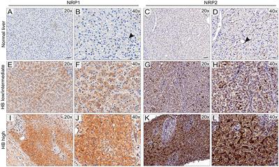 Neuropilin-2 Is Associated With Increased Hepatoblastoma Cell Viability and Motility